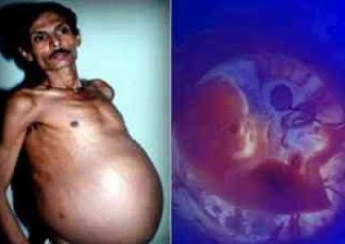 Sanju Bhagat, ‘mengandung’ saudara kembarnya di dalam perut
