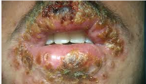 Penyakit  Herpes Di Mulut