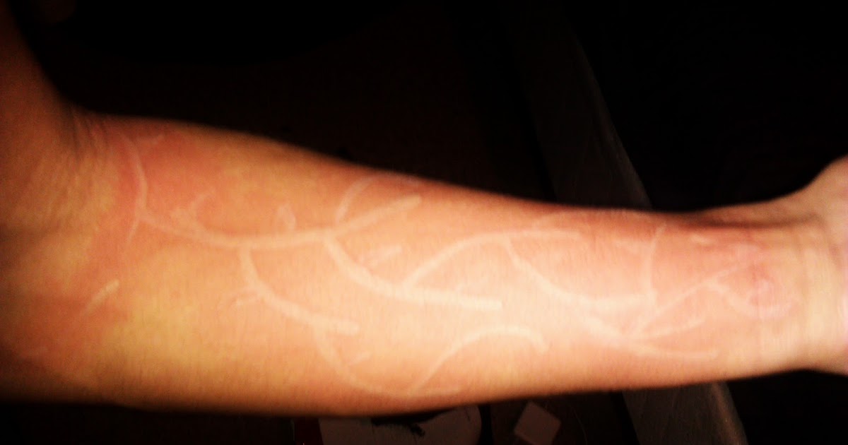 Allergic Reaction Face Rash Pictures Hives Understanding This