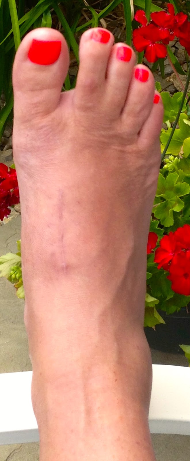 After LisFranc Surgery 11 weeks post lisfranc surgery