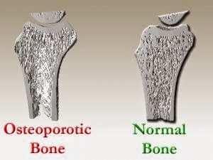 factors that increase the risk of developing osteoporosis While men also develop osteoporosis, this condition is particularly common among women who factors that may increase the risk of osteoporosis include. factors that increase the risk of developing osteoporosis While men also develop osteoporosis, this condition is particularly common among women who factors that may increase the risk of osteoporosis include.