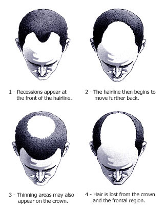 Hair Transplant Guwahati What Causes Hair Loss