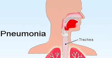 Image result for pengertian pneumonia