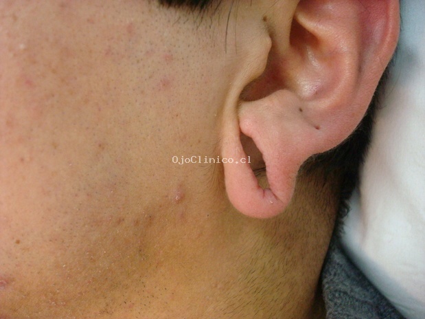 La psoriasis plisado las pieles de la foto