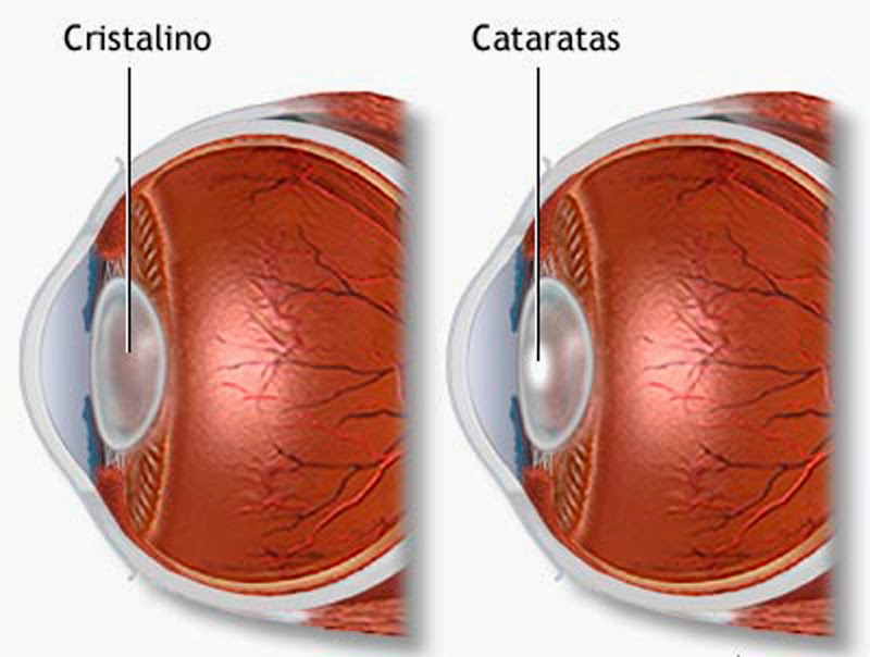 DISTRIBUIDORA OFTÁLMICA VERING ¿Cuándo se deben operar las cataratas?