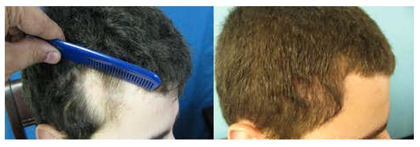 Orange County Hair Transplant Hair Restoration Surgery Vs Hair