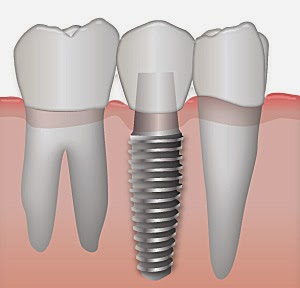 implant dentaire procédure