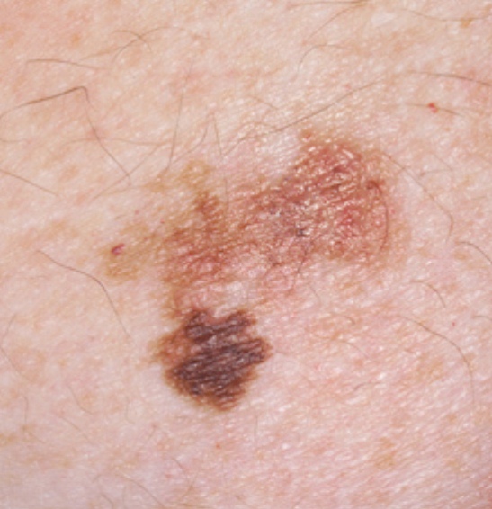 Pictures of skin cancer Skin cancer spots