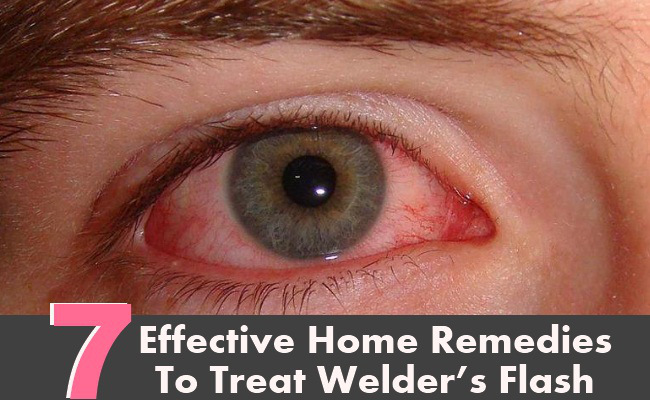 7 Effective Home Remedies To Treat Welder’s Flash ~ I Heart Yin Yang