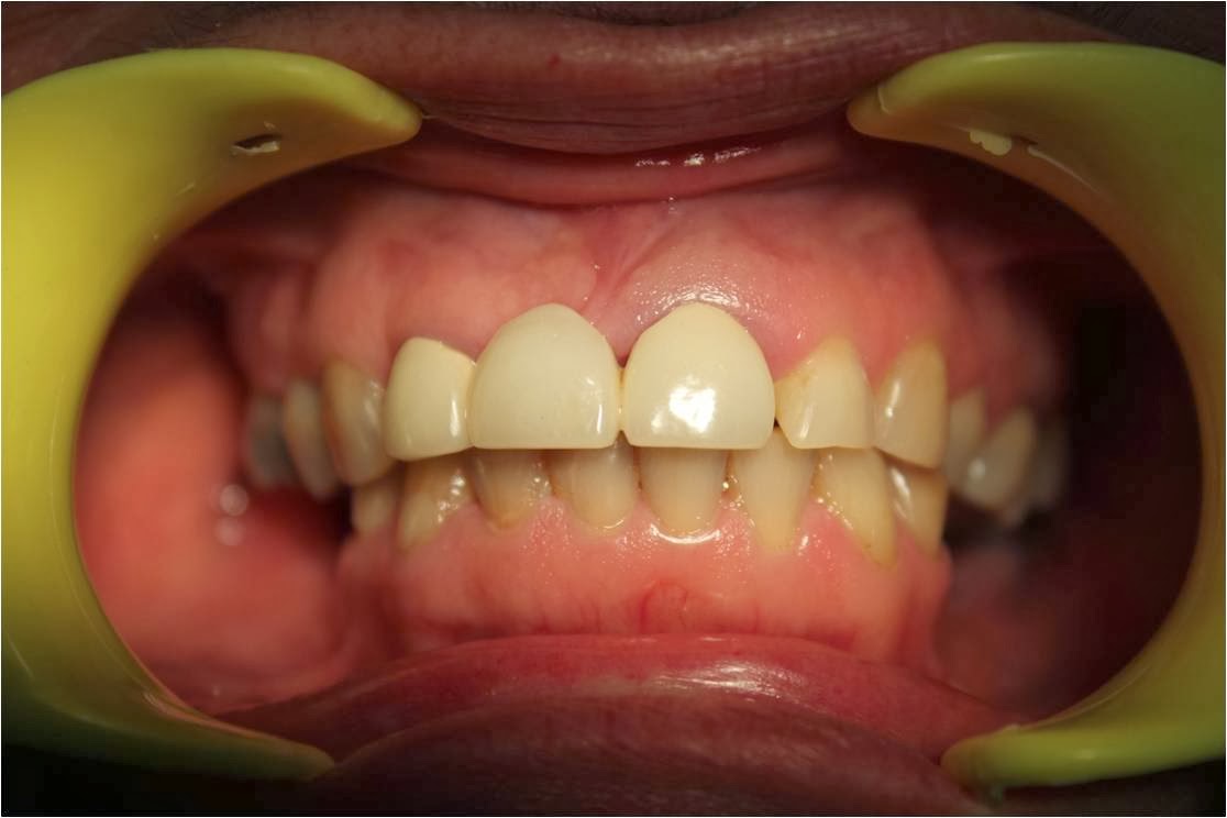 Failed root canal treatment options USING DENTAL IMPLANTS