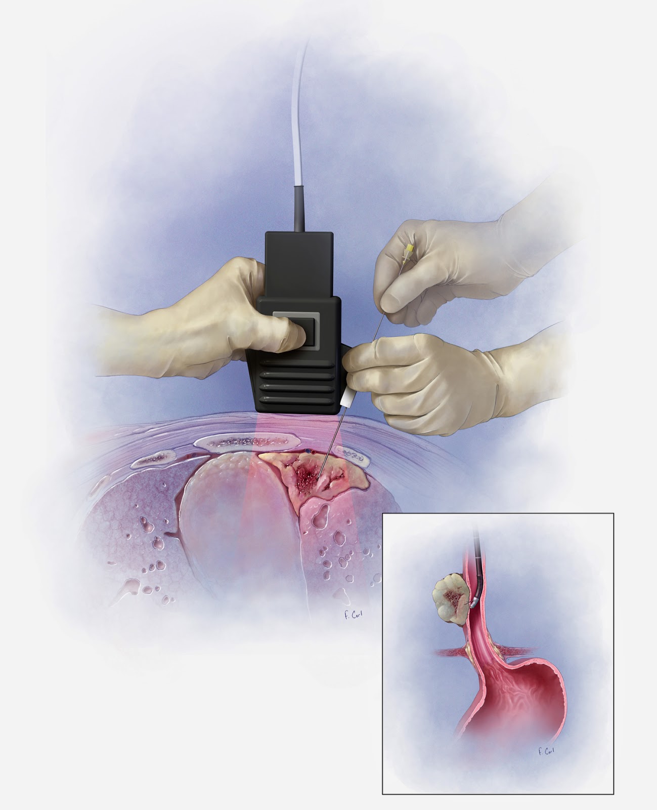 Corl Medical Media Ultrasound Guided Biopsy, 2003