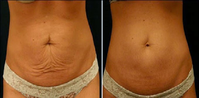 How To Treat Sagging Skin After Weight Loss