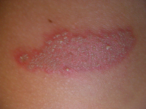 rode vlekken op arm jeuk