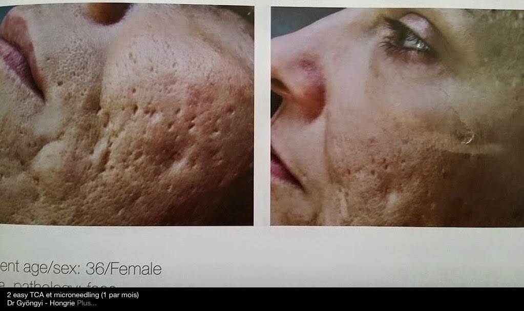 TO PEEL... AVEC EASY TCA UN PEELING MÉDICAL HAUTE PERFORMANCE 3 ÉTAPES + 1.