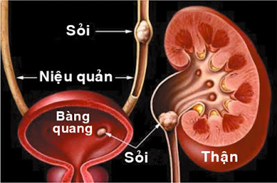 Bị bệnh sỏi thận có thể gây suy thận không?