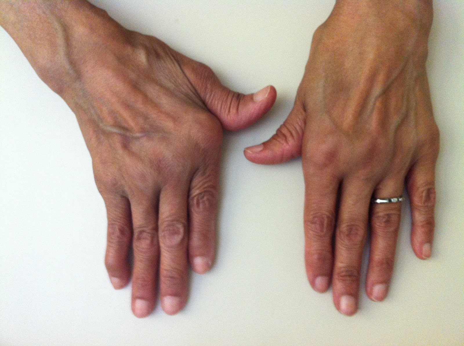 Reumails. Reumatología al día Imágenes y revisión La artropatía de