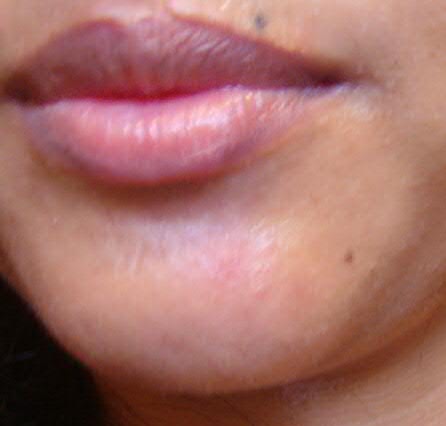 Pimple Below Lip