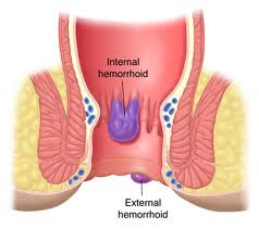 Natural Home Remedies for Hemorrhoids 