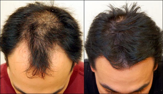 is finasteride for hair loss safe