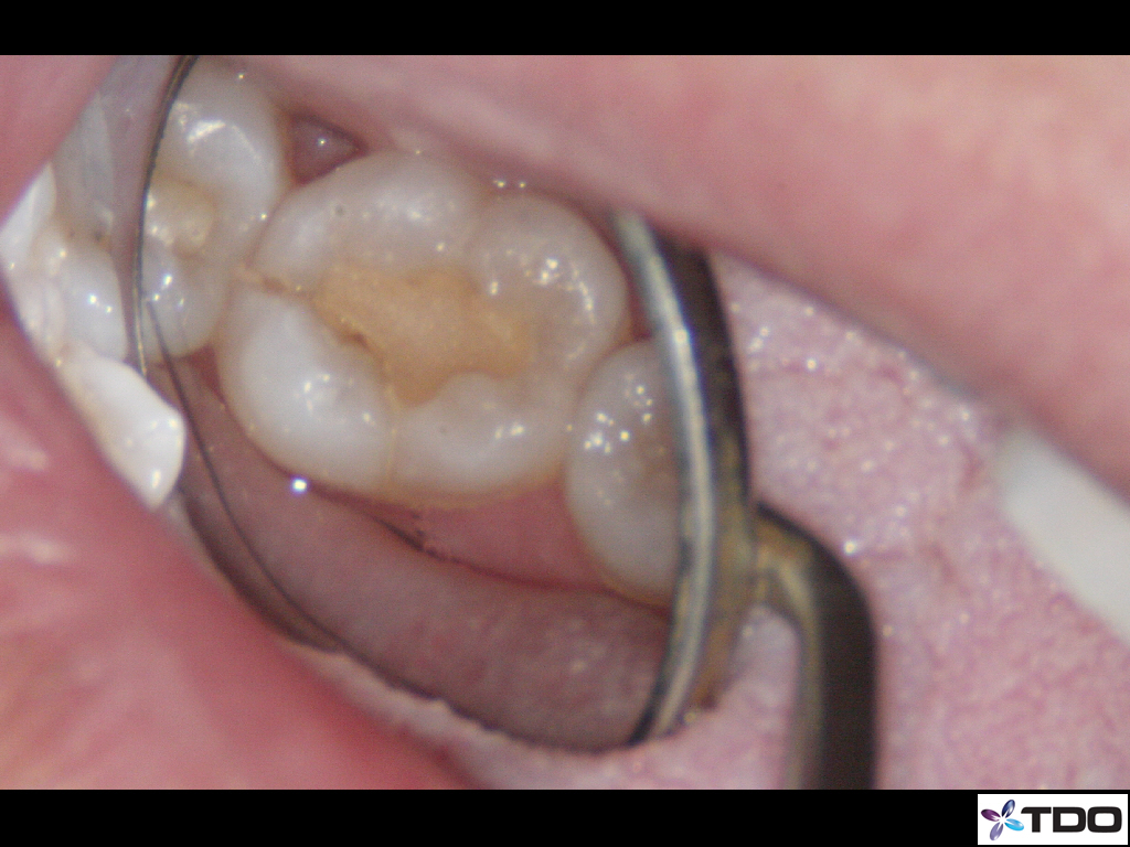 tcdo blog cracked tooth ouch crack in tooth