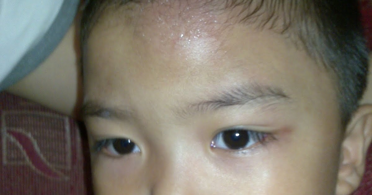 supermommyjane A Bump on the Head of my Toddler