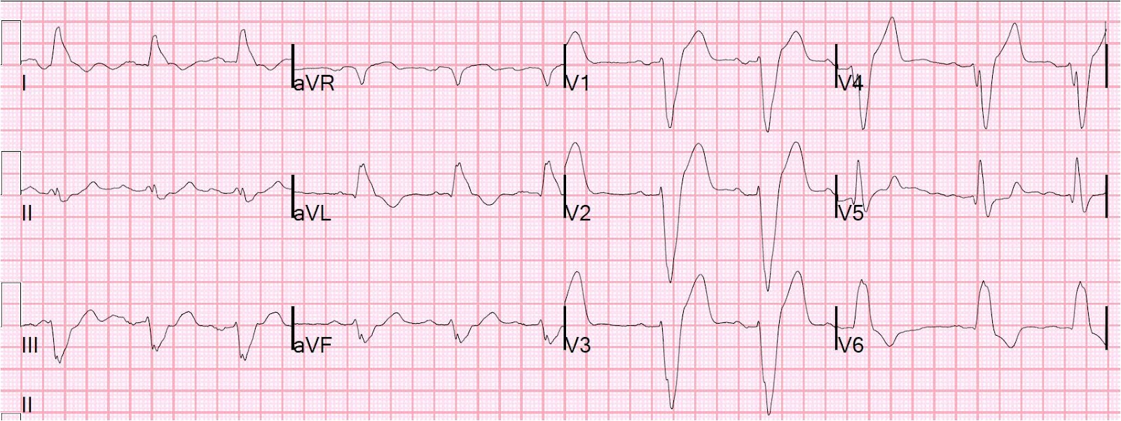 New Lbbb