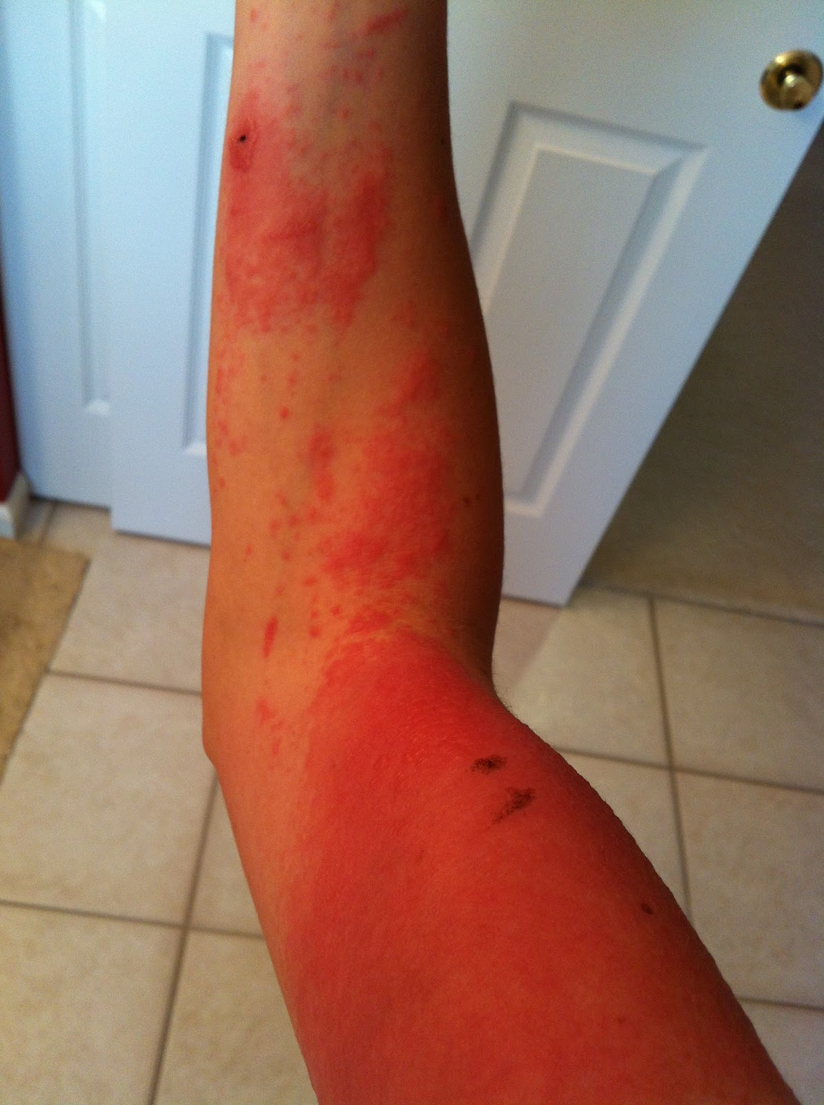 The End of the Poison Ivy Saga. With Pics! Charisa Darling