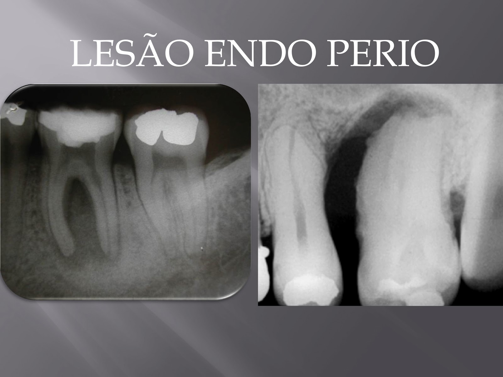 LESÕES ENDOPERIO Dicas de Odontologia da Prof. Alessandra Areas