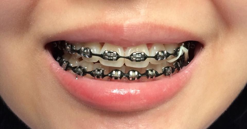 Braces Journey - Chapter 16.0 | Felicia Alexiz | Beauty & Lifestyle