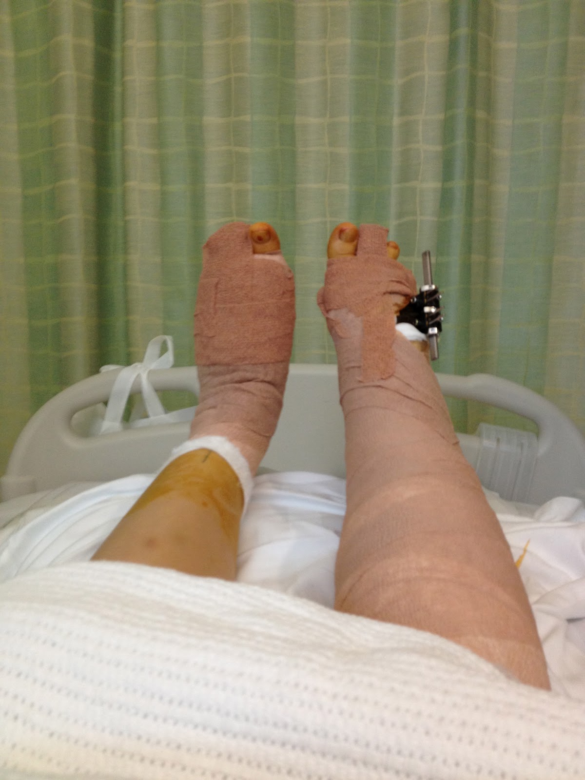 Living with Brachymetatarsia and coping with surgery Post Op.