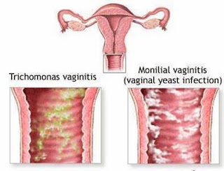 Jamur vagina 