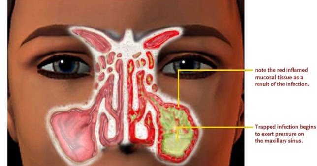 sinus barotrauma