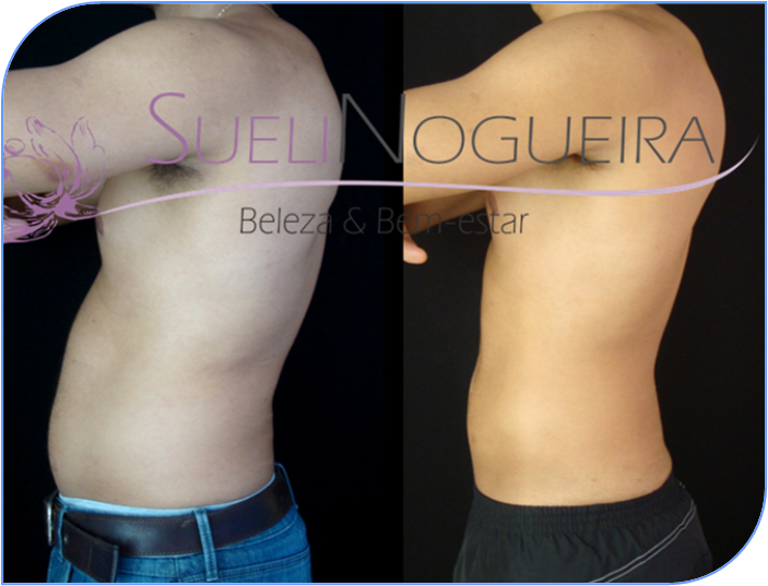 Espaço Sueli Nogueira: Criolipólise - Elimina de 20% à 30% de gordura