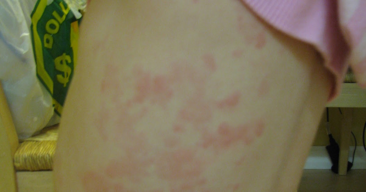 The Hardest Quest Fifth Disease