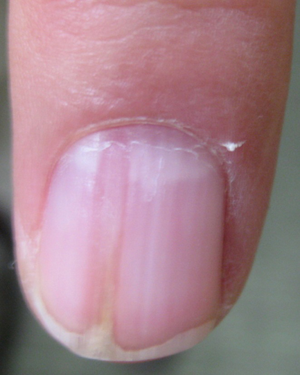 El medio medicinal del hongo sobre las uñas de los pies