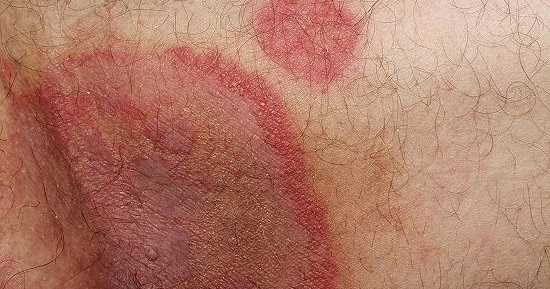 DERMATOFITOSE | CMS Vila Canoas