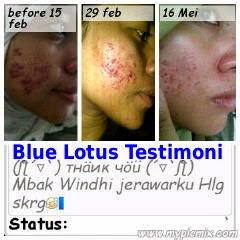 Blue Lotus Acne Skin Series