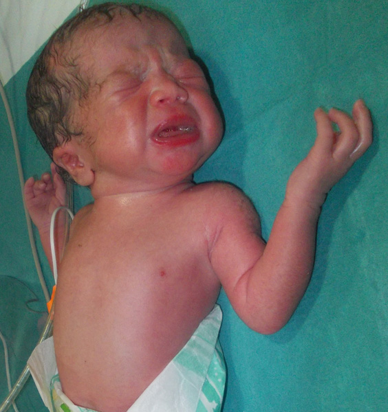 Our Journey with the Twins Vernix and Lanugo