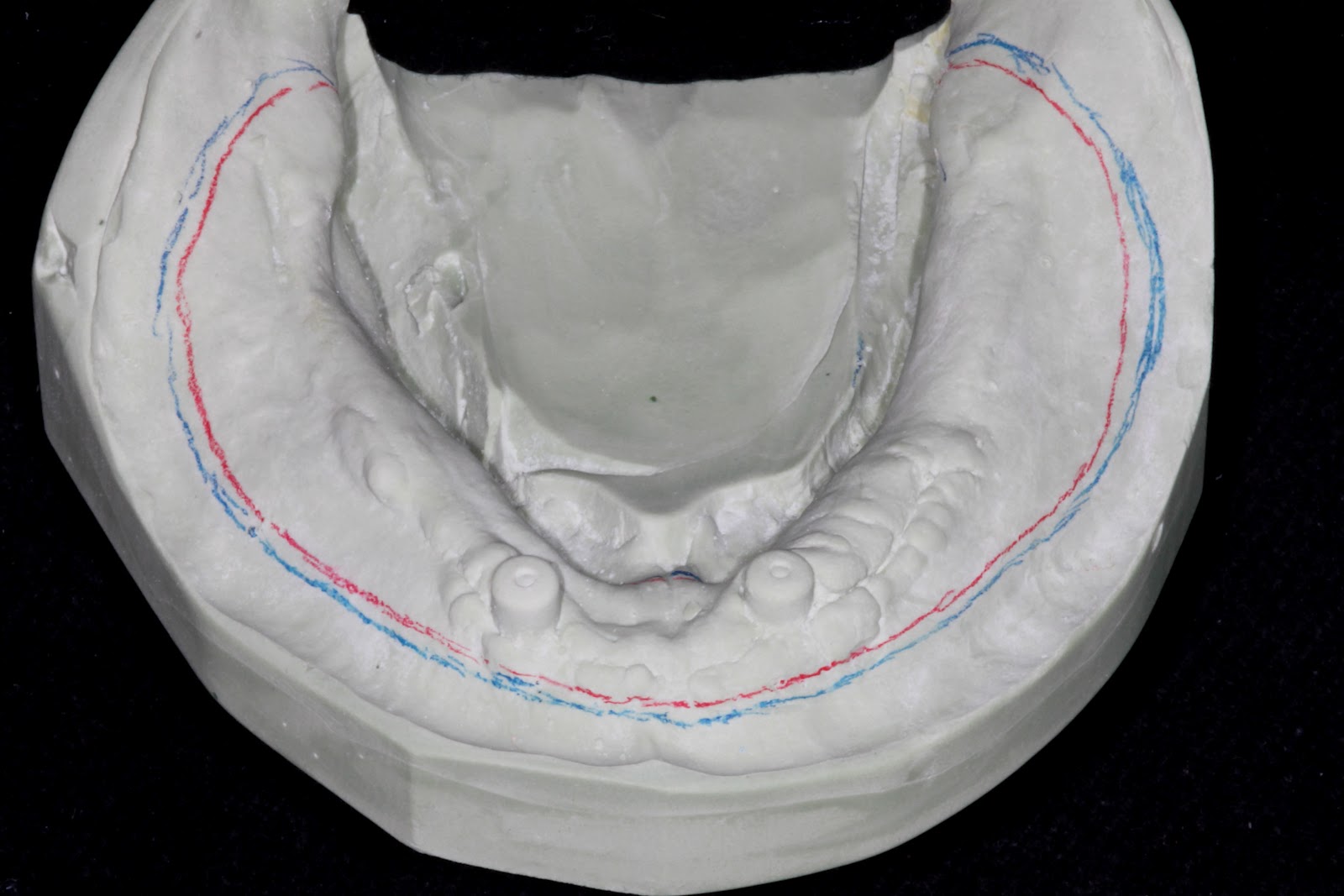 Boise Idaho Prosthodontics Preliminary Mandibular Hybrid Open Tray