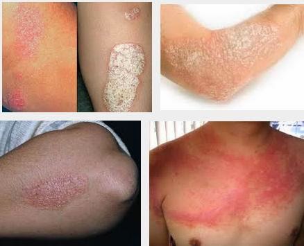 Cara Menyembuhkan Penyakit Psoriasis