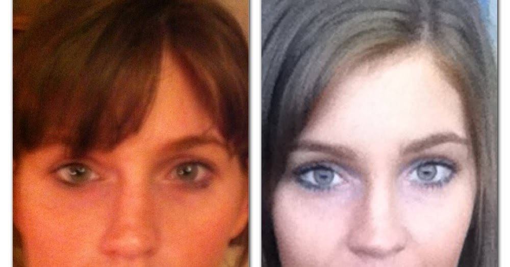 A Guide to Surviving Orthognathic Surgery From the Beginning