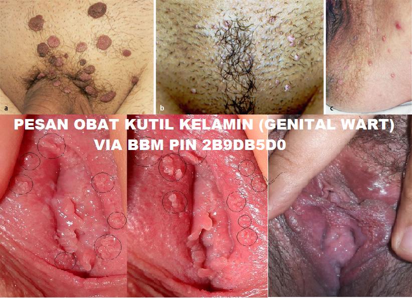 Ciri - Ciri Kutil Kelamin Di Labia Minora Ciri - Ciri Kutil Kelamin Di Labia Minora