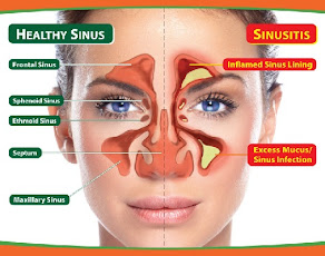 KENALI SINUSITIS/ RESDUNG