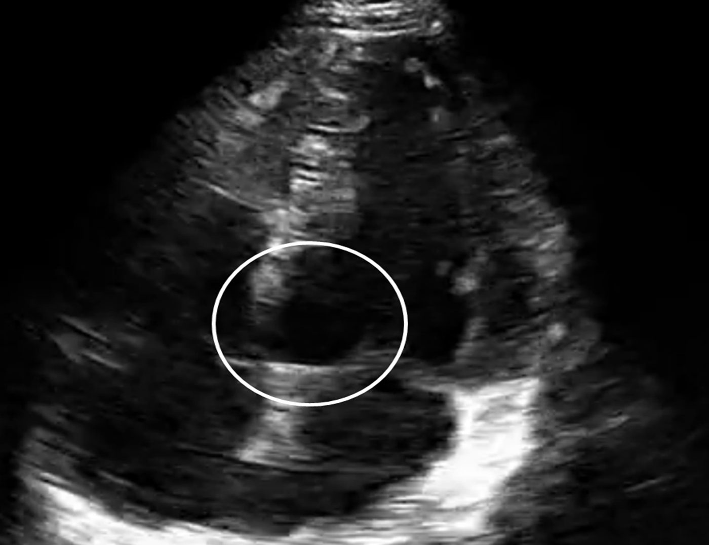 Dr. Smith's ECG Blog ED Bedside Echo for the last very subtle inferior