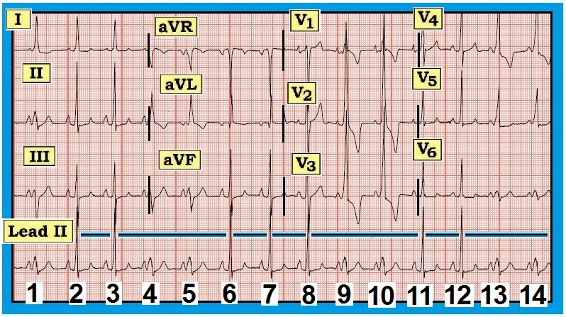 Ecg Interpretation Ecg Interpretation Review 49 Chest Pain