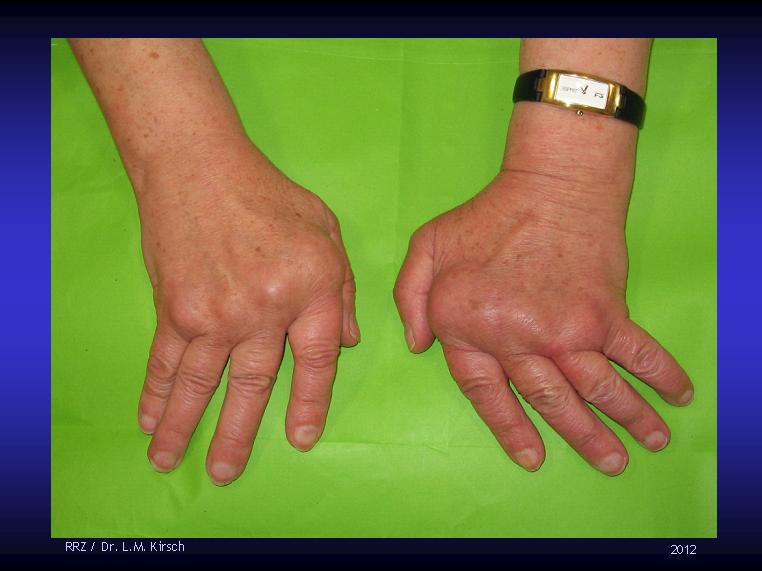 Rheumatologe: Rheumatoid Arthritis / Old and New DMARDs / EULAR and ACR