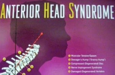 Anterior Head Syndrome