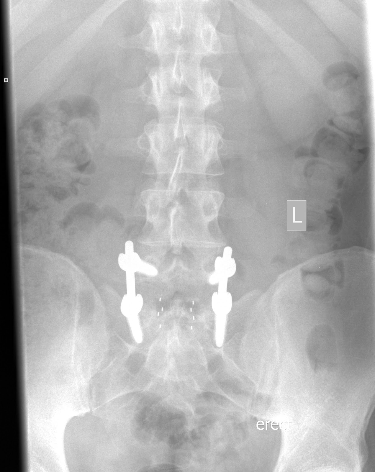 Excuse me...fuse me too!! My story of L5S1 spinal fusion surgery