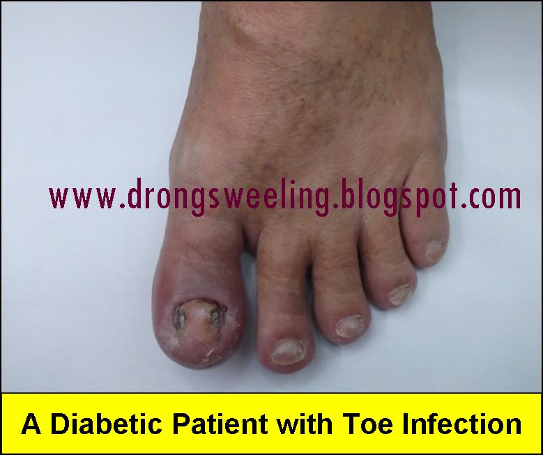 TCM News A Diabetic Patient with Toe Infection