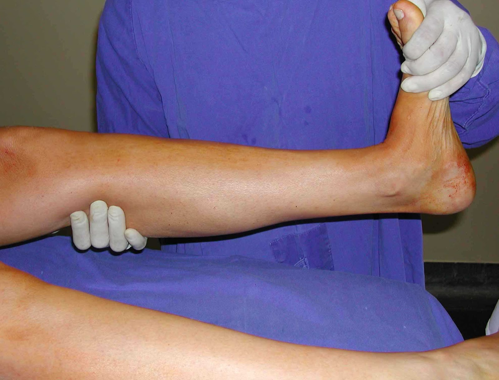 Tromboembolismo Venoso (TEV): Sintomas, Causas e Soluções - Seja Saúde